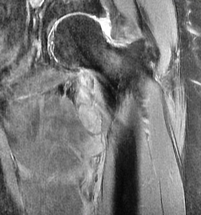 Figure 3 for case Psoas avulsion